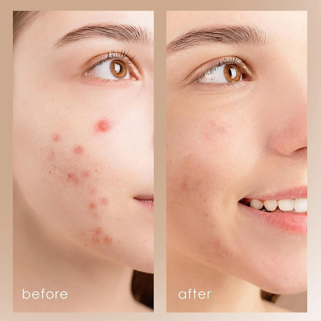 Limpiador Facial Ultrasonico